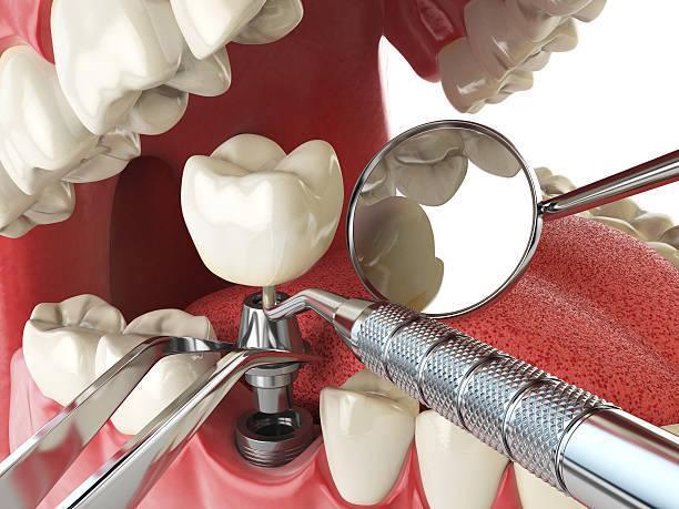 Best Emergency Dental Extractions in Woods Creek, WA